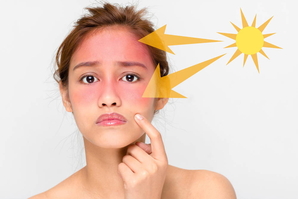 آفتاب سوختگی چیست و چطور درمان می شود